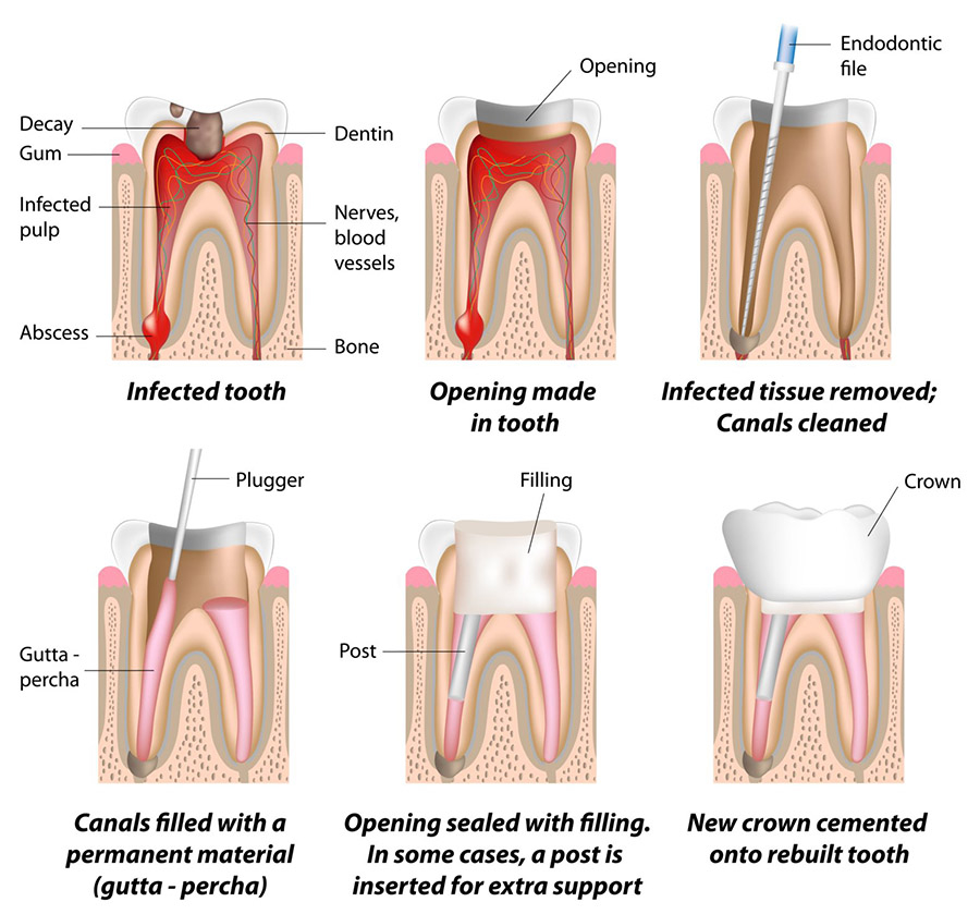 Root Canal Treatment Procedure